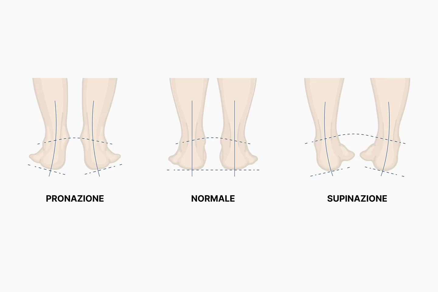 Anomalie nell’assetto della caviglia, pronazione o supinazione, Studio Podologico DiPalma a Lodi