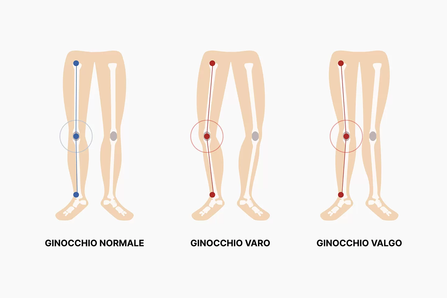Anomalie nell’assetto del ginocchio valgo o varo, Studio Podologico DiPalma a Lodi